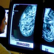 A scan of the woman’s right breast taken at the same time was reported as ‘normal’. However, two years later it was revealed that the scan of her right breast had in fact shown an abnormality.
